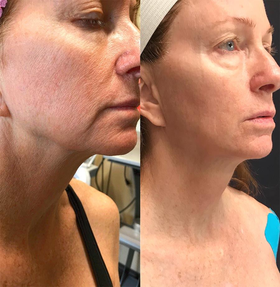 microneedle-fractional-rf before after face1