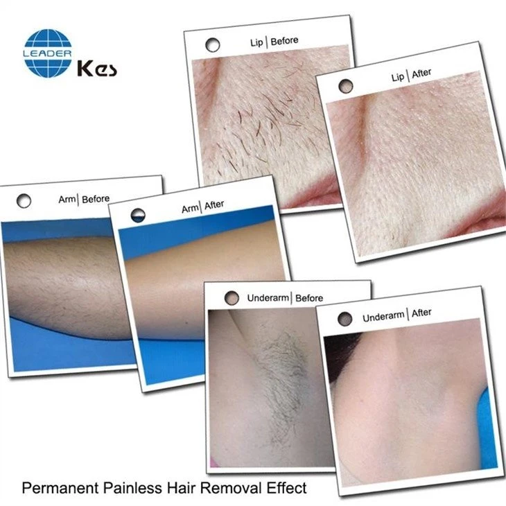 808nm Diode Laser Hair Removal Machine