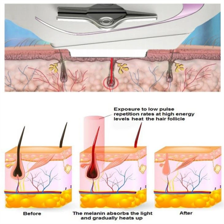 Professional Laser Hair Removal Machine_001