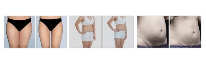 Cryolipolysis Fat Freezing Weight Loss Slimming Machine